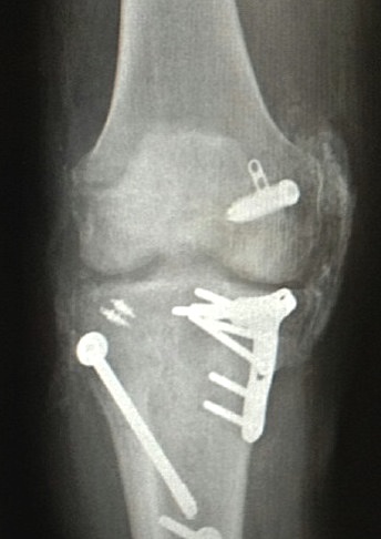 Hetertropic ossification following knee dislocation